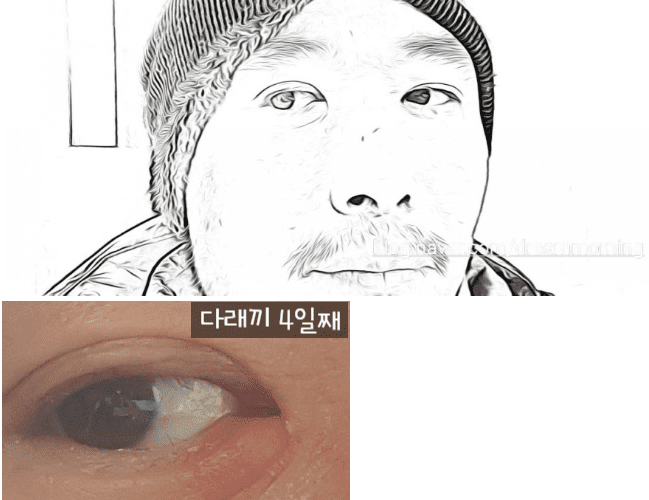 눈다래끼 4일차